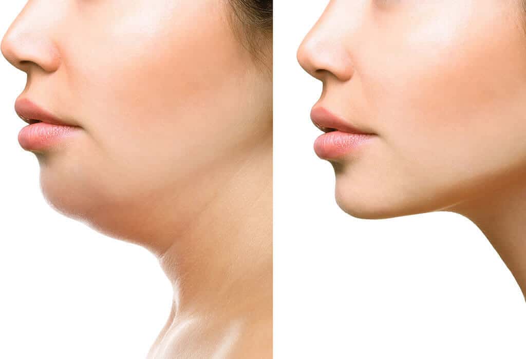 Effects of Losing Weight in your Face