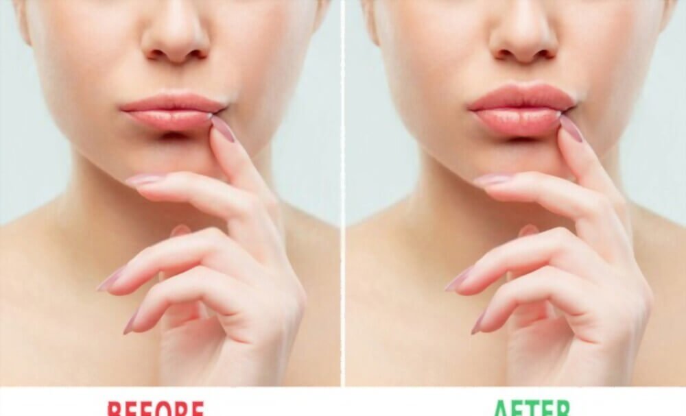 How To Get Bigger Lips Permanently Without Surgery Vaunte