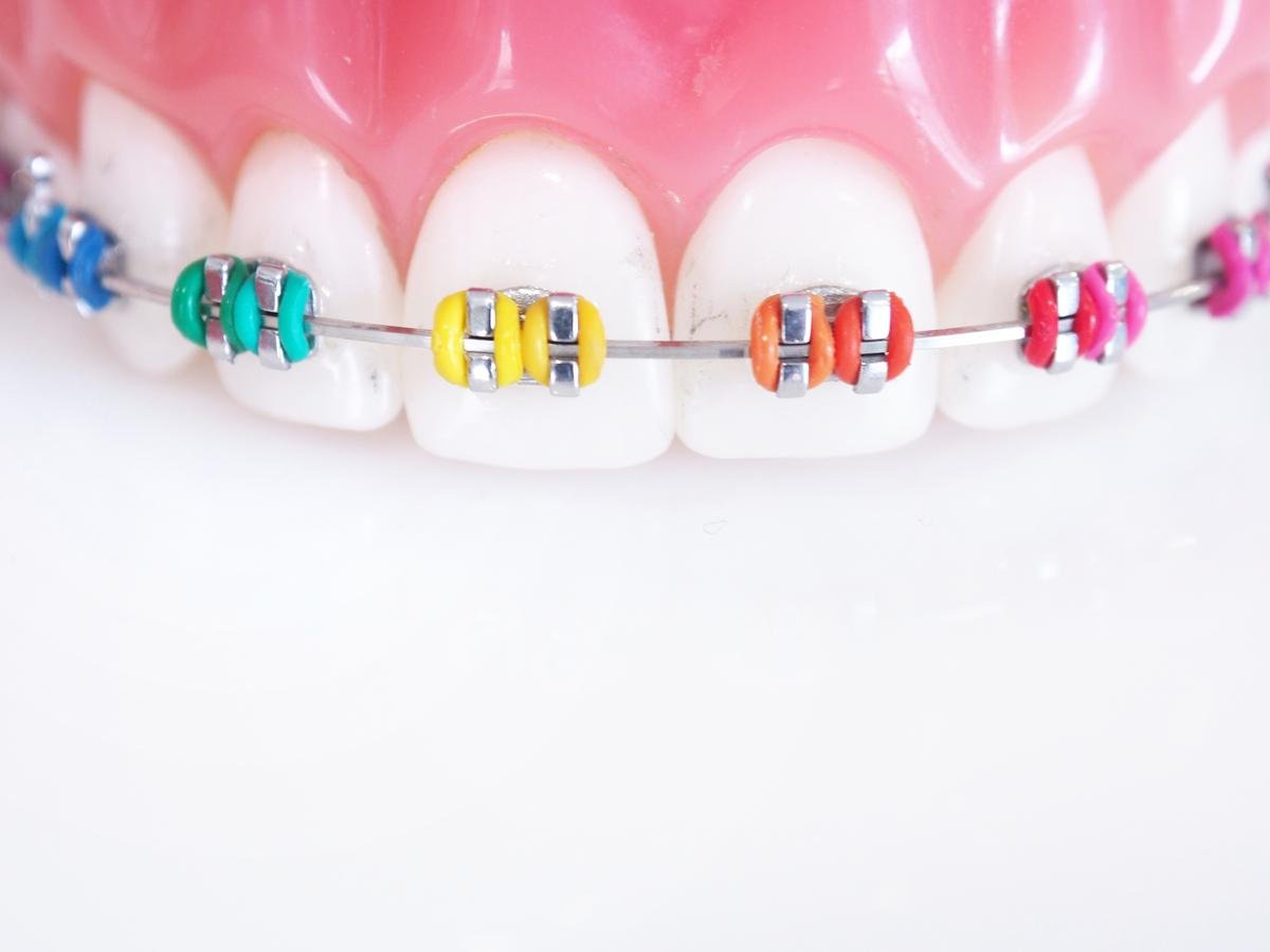 what-is-the-best-color-for-braces-for-yourself-vaunte